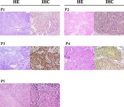 Immune Checkpoint Blockade Therapy May Be a Feasible Option for Primary Pulmonary Lymphoepithelioma-like Carcinoma